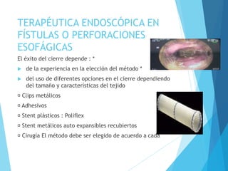 TERAPÉUTICA ENDOSCÓPICA EN
FÍSTULAS O PERFORACIONES
ESOFÁGICAS
El éxito del cierre depende : *
 de la experiencia en la elección del método *
 del uso de diferentes opciones en el cierre dependiendo
del tamaño y características del tejido
Clips metálicos
Adhesivos
Stent plásticos : Poliflex
Stent metálicos auto expansibles recubiertos
Cirugía El método debe ser elegido de acuerdo a cada
 