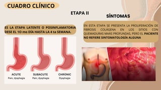 ESOFAGITIS POR CAUSTICOS para estudiantes de medicina | PDF