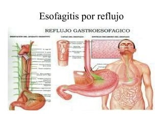 Esofagitis por reflujo[1] | PPT