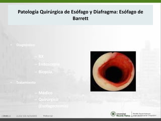 Patología Quirúrgica de Esófago y Diafragma: Esófago de Barrett Diagnóstico RX Endoscopia  Biopsia. Tratamiento Médico Quirúrgico (Esofagectomía) 15 de ago de 2011 CIRUGIA  JUAN SIN NOMBRE 