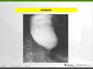 Acalasia 15 de ago de 2011 CIRUGIA  JUAN SIN NOMBRE 