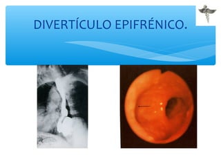 DIVERTÍCULO EPIFRÉNICO.
 