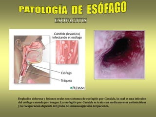 Deglución dolorosa y lesiones orales son síntomas de esofagitis por Candida, la cual es una infección
del esófago causada por hongos. La esofagitis por Candida se trata con medicamentos antimicóticos
y la recuperación depende del grado de inmunosupresión del paciente.
 