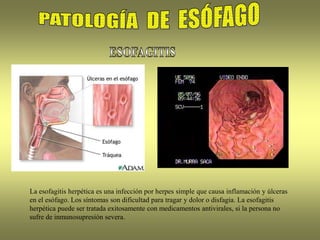 La esofagitis herpética es una infección por herpes simple que causa inflamación y úlceras
en el esófago. Los síntomas son dificultad para tragar y dolor o disfagia. La esofagitis
herpética puede ser tratada exitosamente con medicamentos antivirales, si la persona no
sufre de inmunosupresión severa.
 