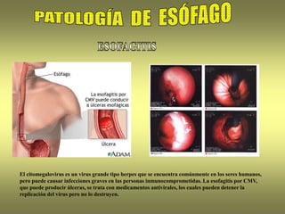 El citomegalovirus es un virus grande tipo herpes que se encuentra comúnmente en los seres humanos,
pero puede causar infecciones graves en las personas inmunocomprometidas. La esofagitis por CMV,
que puede producir úlceras, se trata con medicamentos antivirales, los cuales pueden detener la
replicación del virus pero no lo destruyen.
 