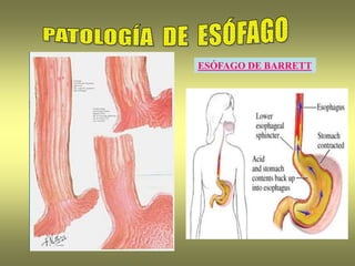 ESÓFAGO DE BARRETT
 