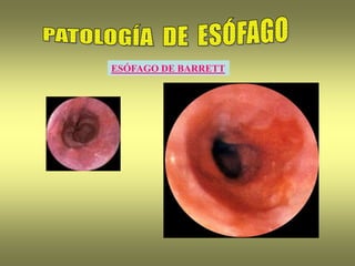 ESÓFAGO DE BARRETT
 