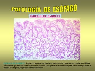 ESÓFAGO DE BARRETT
ESOFAGO DE BARRETT: Se observa una mucosa glandular que recuerda a una mucosa cardial, con células
caliciformes que alternan con células de tipo foveolar (metaplasia intestinal incompleta) El borde superior de la
mucosa es irregular, sugiriendo un aspecto velloso.
 