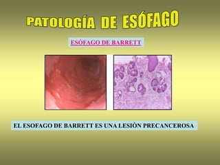 ESÓFAGO DE BARRETT
EL ESOFAGO DE BARRETT ES UNA LESIÒN PRECANCEROSA
 