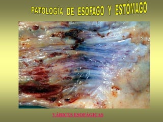 VÁRICES ESOFÁGICAS
 
