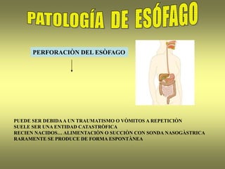 PERFORACIÒN DEL ESÒFAGO
PUEDE SER DEBIDAA UN TRAUMATISMO O VÒMITOS A REPETICIÒN
SUELE SER UNA ENTIDAD CATASTRÒFICA
RECIEN NACIDOS… ALIMENTACIÒN O SUCCIÒN CON SONDA NASOGÀSTRICA
RARAMENTE SE PRODUCE DE FORMA ESPONTÀNEA
 