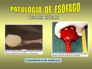 LEIOMIOMAS DE ESÒFAGO
 
