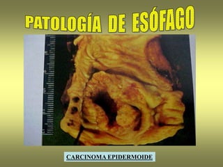 CARCINOMA EPIDERMOIDE
 