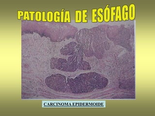 CARCINOMA EPIDERMOIDE
 