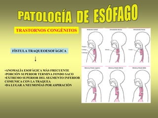 TRASTORNOS CONGÈNITOS
FÌSTULA TRAQUEOESOFÀGICA
•ANOMALÌA ESOFÀGICA MÀS FRECUENTE
•PORCIÒN SUPERIOR TERMINA FONDO SACO
•EXTREMO SUPERIOR DEL SEGMENTO INFERIOR
COMUNICA CON LA TRAQUEA
•DA LUGAR A NEUMONÌAS POR ASPIRACIÒN
 