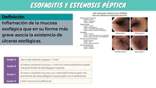 Esofagatis ESOFAGO.pdf