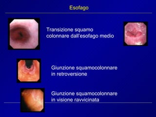 Esofago Giunzione squamocolonnare in retroversione Giunzione squamocolonnare in visione ravvicinata Transizione squamo colonnare dall’esofago medio