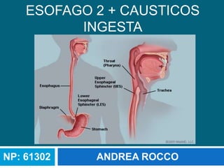 ESOFAGO 2 + CAUSTICOS
          INGESTA




NP: 61302   ANDREA ROCCO
 