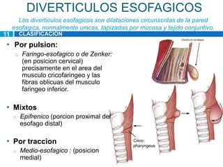 DIVERTICULOS ESOFAGICOS
       Los diverticulos esofagicos son dilataciones circunscritas de la pared
     esofagica, normalmente unicas, tapizadas por mucosa y tejido conjuntivo.
11        CLASIFICACION

 • Por pulsion:
      o   Faringo-esofagico o de Zenker:
          (en posicion cervical)
          precisamente en el area del
          musculo cricofaringeo y las
          fibras oblicuas del musculo
          faringeo inferior.

 • Mixtos
     o    Epifrenico (porcion proximal del
          esofago distal)

 • Por traccion
     o    Medio-esofagico : (posicion
          medial)
 