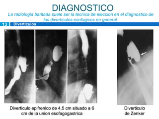 DIAGNOSTICO
     La radiologia baritada suele ser la tecnica de eleccion en el diagnostico de
                        los diverticulos esofagicos en general.
13     Diverticulos
       esofagicos




     Diverticulo epifrenico de 4.5 cm situado a 6                Diverticulo
           cm de la union esofagogastrica                        de Zenker
 