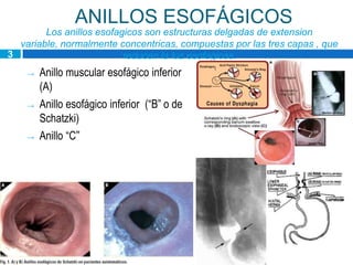 ANILLOS ESOFÁGICOS
        Los anillos esofagicos son estructuras delgadas de extension
  variable, normalmente concentricas, compuestas por las tres capas , que
3                         reducen la luz esofagicas.
    →   Anillo muscular esofágico inferior
        (A)
    →   Anillo esofágico inferior (“B” o de
        Schatzki)
    →   Anillo “C”
 