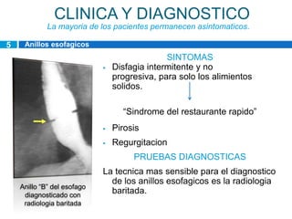 CLINICA Y DIAGNOSTICO
             La mayoria de los pacientes permanecen asintomaticos.

5    Anillos esofagicos
                                               SINTOMAS
                                Disfagia intermitente y no
                                 progresiva, para solo los alimientos
                                 solidos.

                                   “Sindrome del restaurante rapido”
                                Pirosis
                                Regurgitacion
                                      PRUEBAS DIAGNOSTICAS
                             La tecnica mas sensible para el diagnostico
                               de los anillos esofagicos es la radiologia
    Anillo “B” del esofago
     diagnosticado con
                               baritada.
     radiologia baritada
 