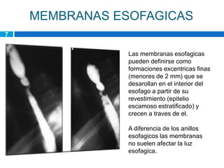 MEMBRANAS ESOFAGICAS
7


                Las membranas esofagicas
                pueden definirse como
                formaciones excentricas finas
                (menores de 2 mm) que se
                desarollan en el interior del
                esofago a partir de su
                revestimiento (epitelio
                escamoso estratificado) y
                crecen a traves de el.

                A diferencia de los anillos
                esofagicos las membranas
                no suelen afectar la luz
                esofagica.
 