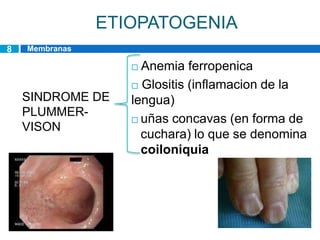 ETIOPATOGENIA
8   Membranas
    esofagicas
                     Anemia ferropenica
                     Glositis (inflamacion de la
    SINDROME DE     lengua)
    PLUMMER-
                     uñas concavas (en forma de
    VISON
                      cuchara) lo que se denomina
                      coiloniquia
 
