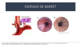 ESOFAGO DE BARRET
)ACG Clinical Guideline: Diagnosis and Management of Barrett’s Esophagus, American Journal of Gastroenterolog: January 2016 - Volume 111 - Issue 1 - p 30-50 doi: 10.1038/ajg.2015.322, REV.
MED. CLIN. CONDES - 2015; 26(5) 557-564, Martin. H. Floch, F., 2006. Netter gastroenterologia. Barcelona: Elsevier masson pag 91-95.
 