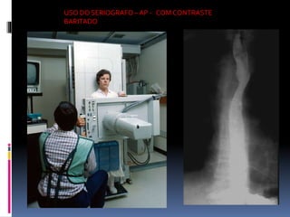 USO DO SERIOGRAFO – AP - COM CONTRASTE
BARITADO
 