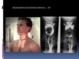 RADIOGRAFIA DO ESOFAGOCERVICAL -- AP
 