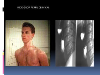 INCIDENCIA PERFILCERVICAL
 