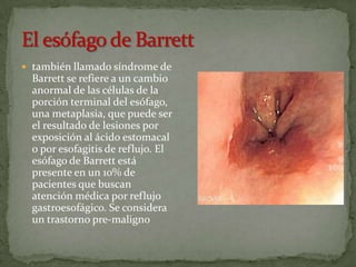  también llamado síndrome de
  Barrett se refiere a un cambio
  anormal de las células de la
  porción terminal del esófago,
  una metaplasia, que puede ser
  el resultado de lesiones por
  exposición al ácido estomacal
  o por esofagitis de reflujo. El
  esófago de Barrett está
  presente en un 10% de
  pacientes que buscan
  atención médica por reflujo
  gastroesofágico. Se considera
  un trastorno pre-maligno
 