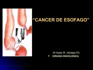 ““CANCER DE ESOFAGO”CANCER DE ESOFAGO”

Dr.Isaac R. veizaga Ch.Dr.Isaac R. veizaga Ch.
 CIRUGIA ONCOLOGICACIRUGIA ONCOLOGICA
 