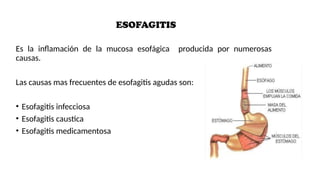 Estudio de patologias esofágicas benignas | PPTX