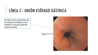 LÍNEA Z - UNIÓN ESÓFAGO GÁSTRICA
Cambio de la coloración de
la mucosa esofágica (rosa
pálida) a mucosa gástrica
(rosa naranja)
 