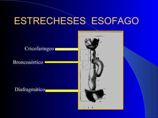 ESTRECHESES ESOFAGO
Cricofaringeo
Broncoaórtico
Diafragmático
 