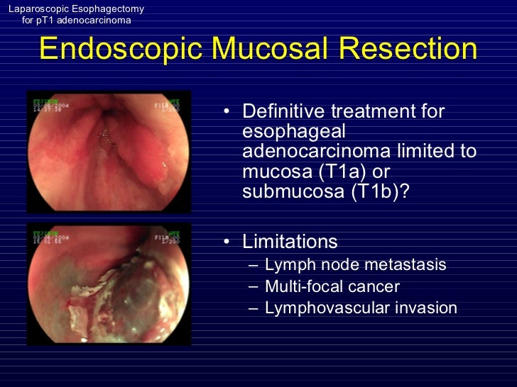 Esophageal adenocarcinoma p t1 sages