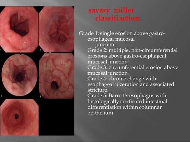 Esophageal and extraesophageal management of GERD