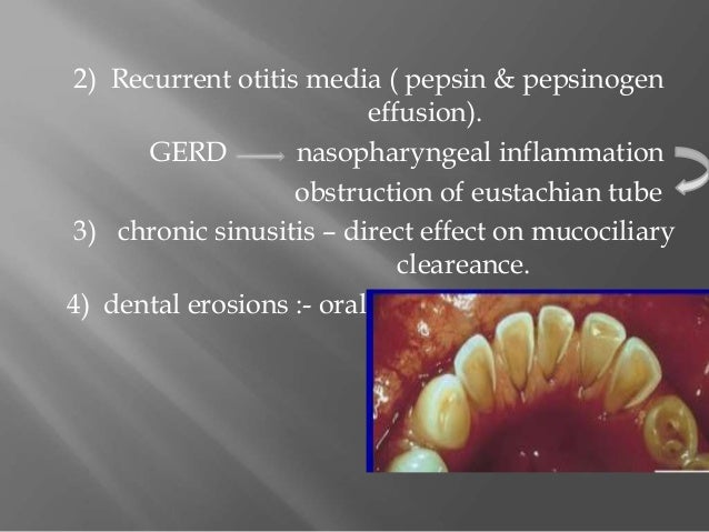 Esophageal and extraesophageal management of GERD