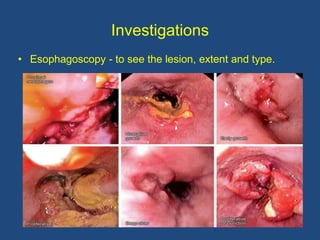 Investigations
• Esophagoscopy - to see the lesion, extent and type.
 