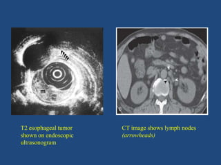 T2 esophageal tumor
shown on endoscopic
ultrasonogram
CT image shows lymph nodes
(arrowheads)
 