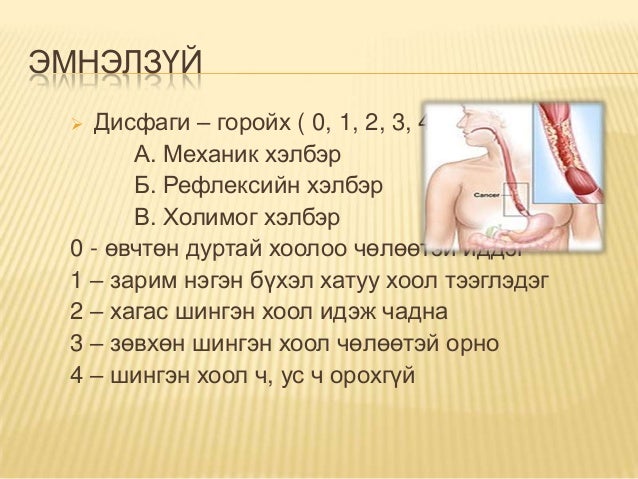 Улаан хоолойн хавдар