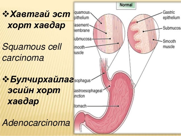 Улаан хоолойн хавдар