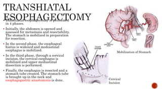 Esophageal cancer | PPTX