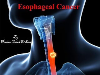 Esophageal cancer | PPT