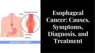 Esophageal
Cancer: Causes,
Symptoms,
Diagnosis, and
Treatment
Esophageal
Cancer: Causes,
Symptoms,
Diagnosis, and
Treatment
 