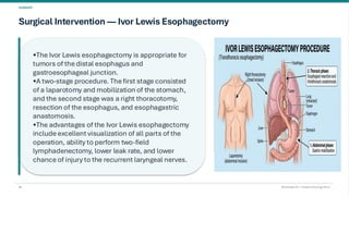 Esophageal Cancer & it's Management. pdf
