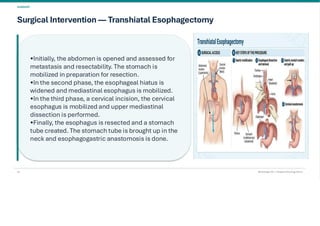 Esophageal Cancer & it's Management. pdf