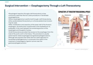 Esophageal Cancer & it's Management. pdf